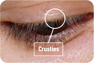 eyelid affected by demodex blepharitis with visible crusties also known as collarettes