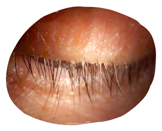 eyelid afflicted with demodex blepharitis db