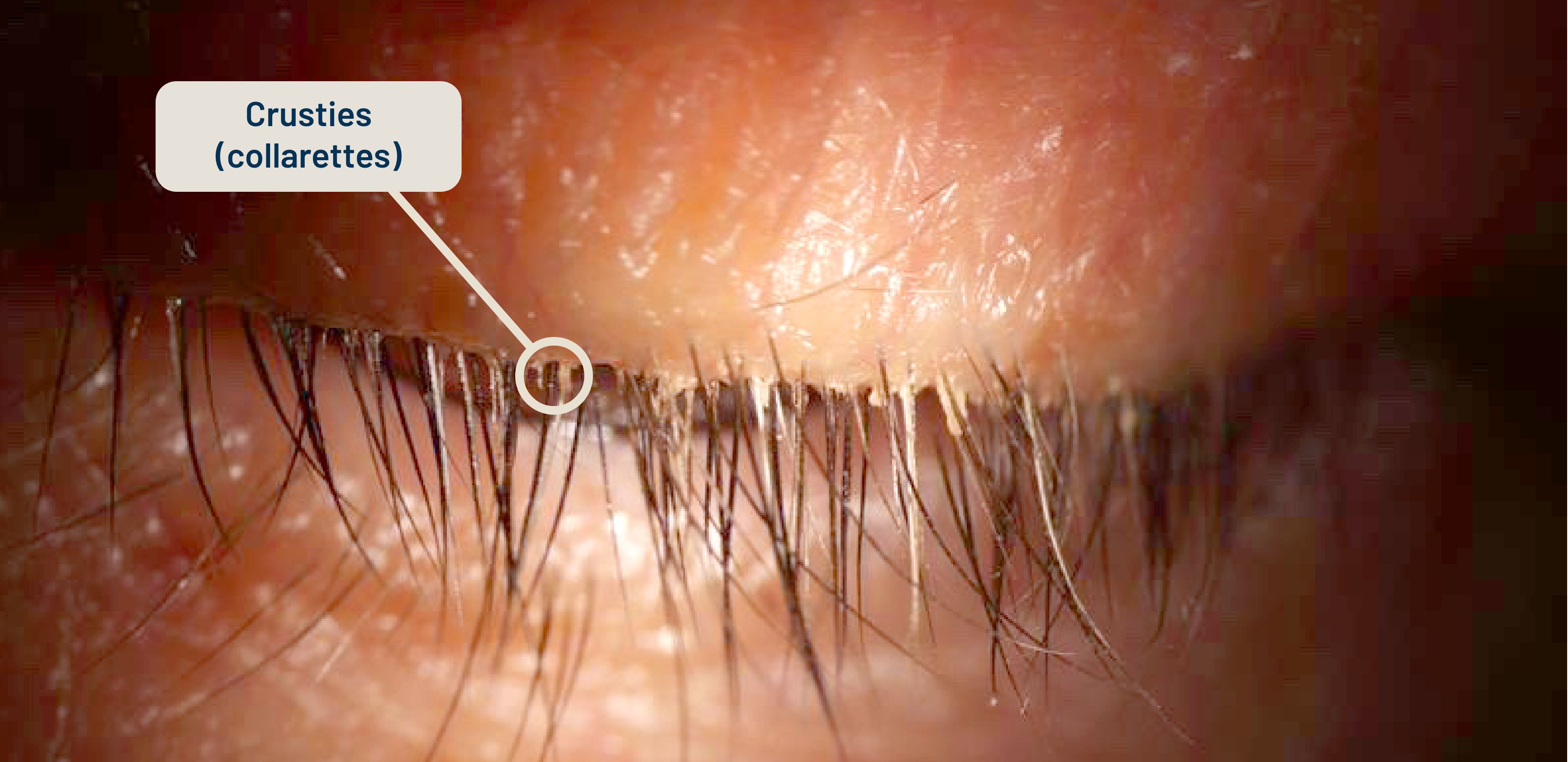 image of before and after treatment with xdemvy