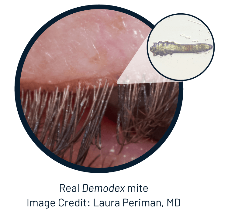 closeup shot of eyelid afflicted with demodex blepharitis db