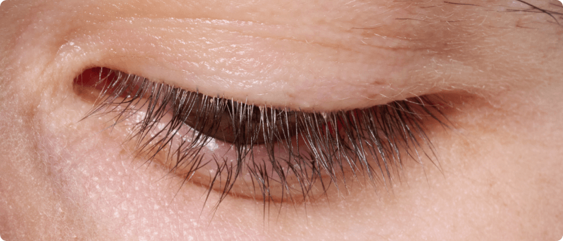 image of after treatment with xdemvy