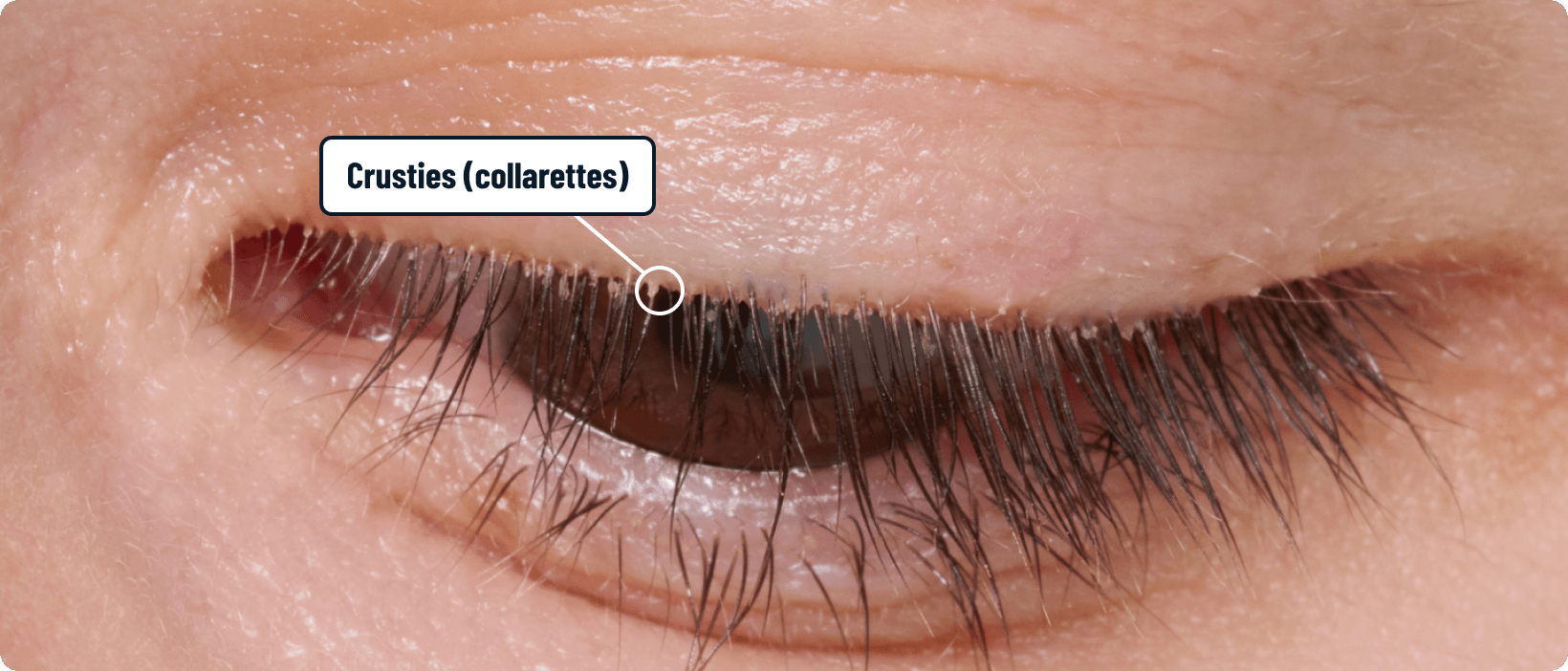 image of before treatment with xdemvy