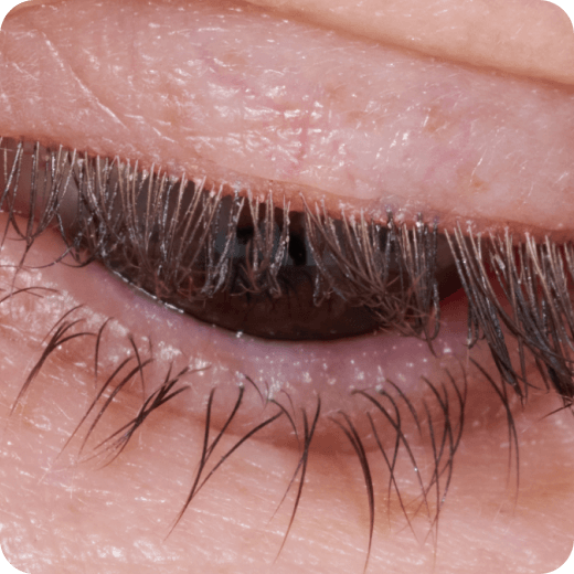 Eyelid closeup.