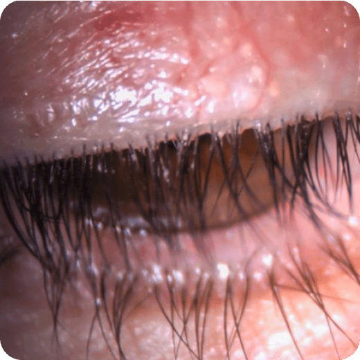 Eyelid closeup.