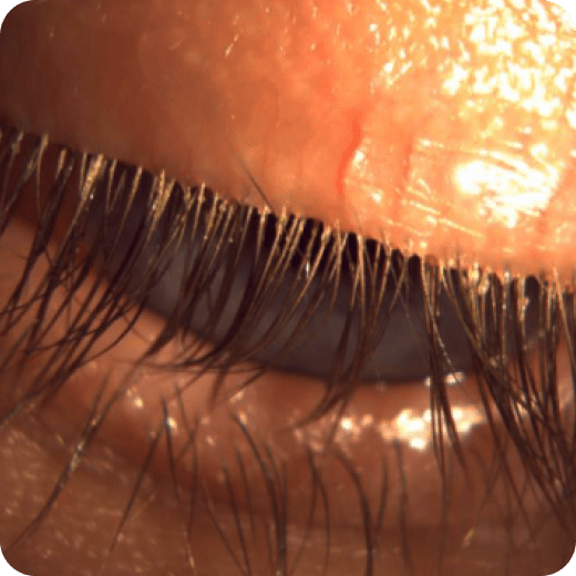Eyelid closeup.