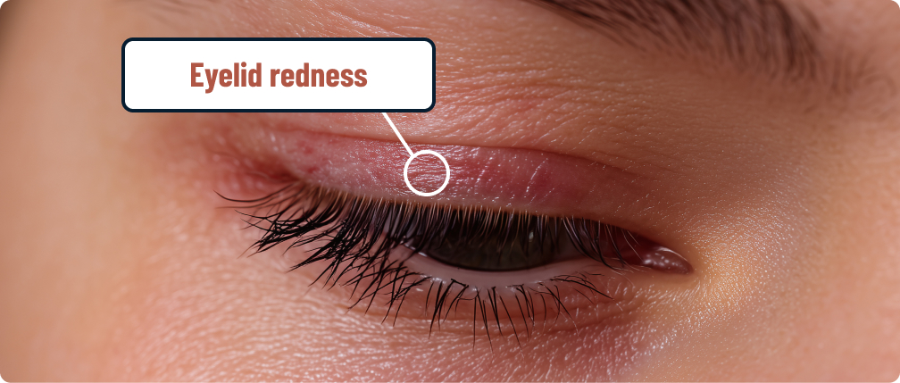 Eyelid Redness